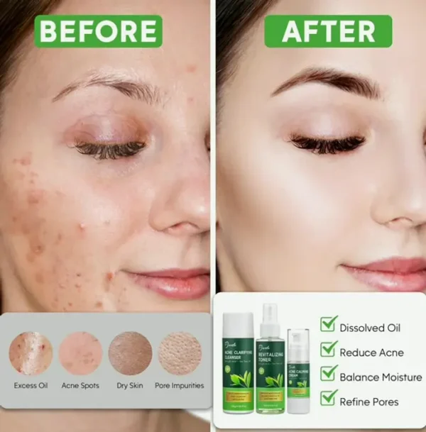 Acne Care Kit for Women, 3-Step Routine