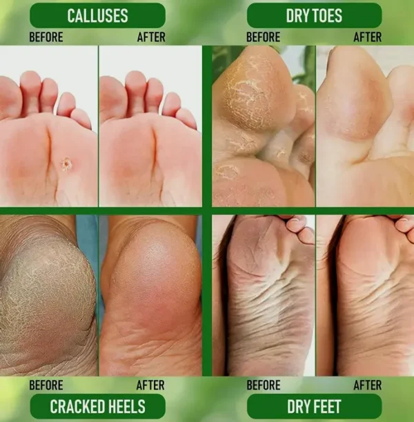 Urea 40% Foot Cream for Dry Feet